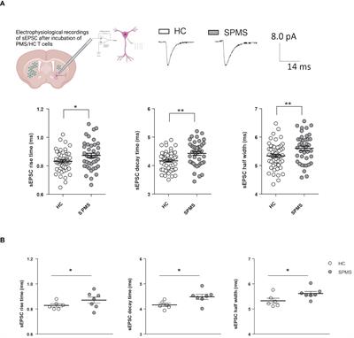 Re-emergence of T lymphocyte-mediated synaptopathy in progressive multiple sclerosis